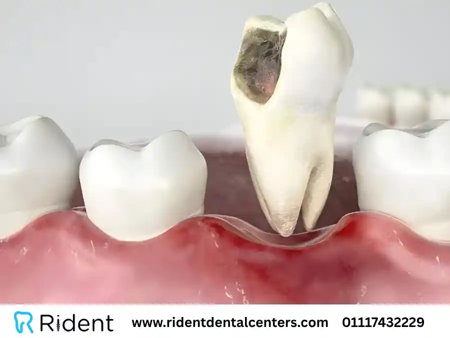 الضرس المسوس | الأسباب والأعراض والعلاج